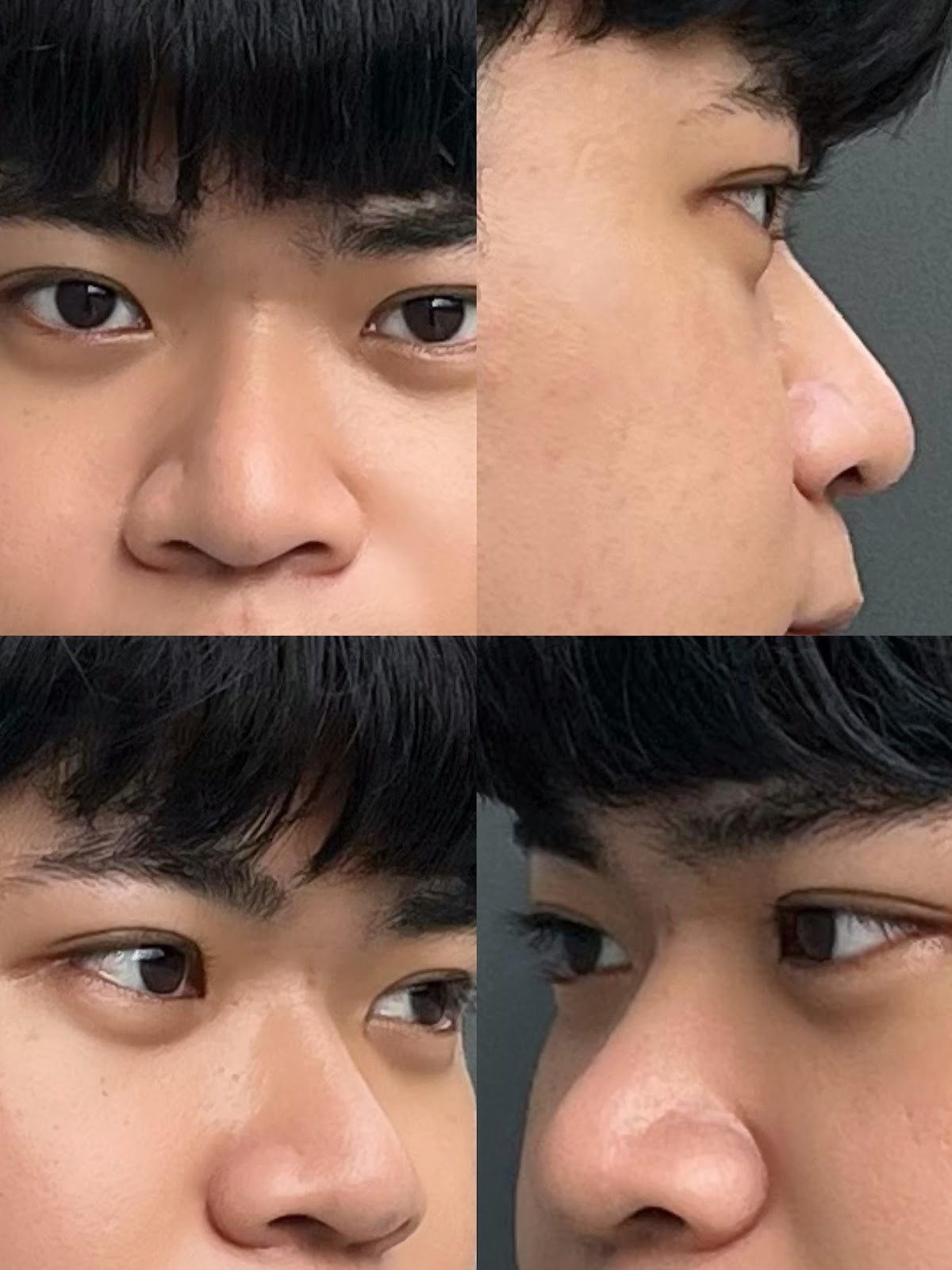 陳裕豪醫師4D三段式埋線隆鼻|皮醫美南勢角診所