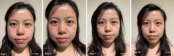 陳裕豪醫師雞尾酒技術皮秒除斑|皮醫美南勢角診所