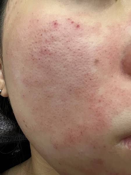 陳裕豪醫師雞尾酒技術皮秒除斑|皮醫美南勢角診所