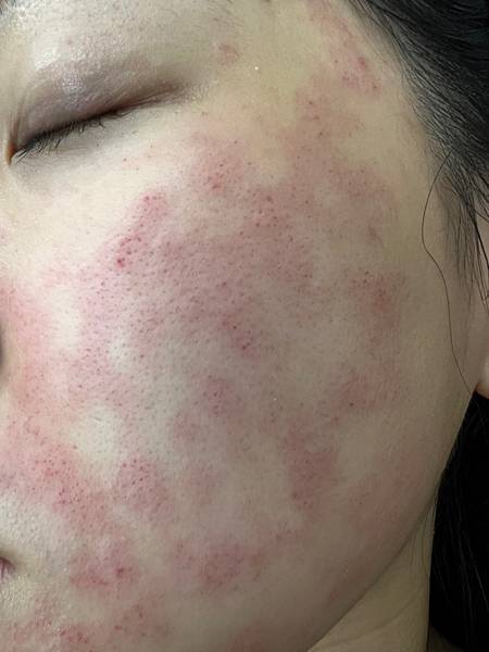陳裕豪醫師雞尾酒技術皮秒除斑|皮醫美南勢角診所