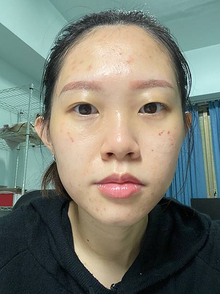 陳裕豪醫師雞尾酒技術皮秒除斑|皮醫美南勢角診所