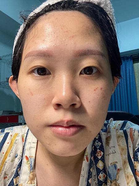 陳裕豪醫師雞尾酒技術皮秒除斑|皮醫美南勢角診所