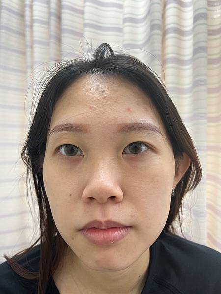 陳裕豪醫師雞尾酒技術皮秒除斑|皮醫美南勢角診所