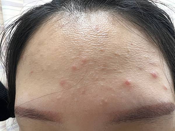 陳裕豪醫師雞尾酒技術皮秒除斑|皮醫美南勢角診所