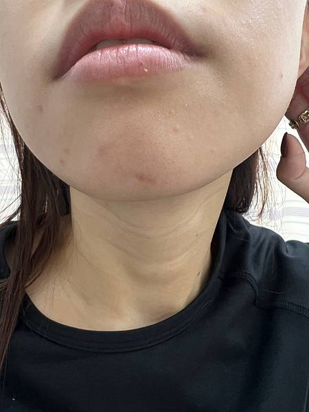 陳裕豪醫師雞尾酒技術皮秒除斑|皮醫美南勢角診所