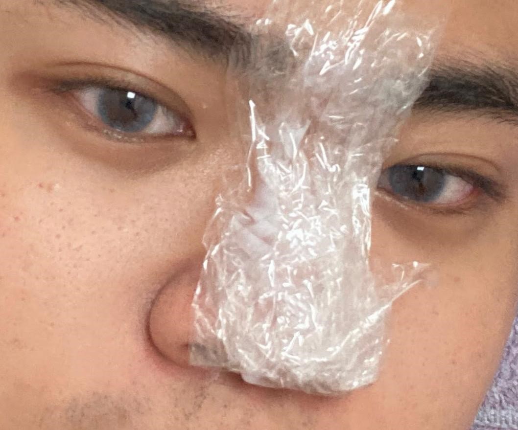 陳裕豪醫師4D三段式埋線隆鼻|皮醫美南勢角診所