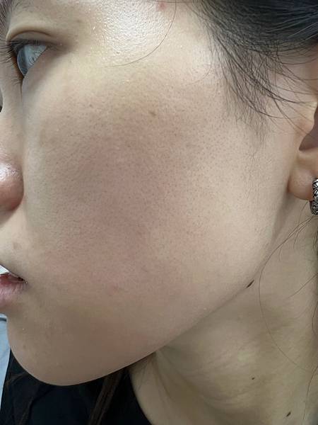 陳裕豪醫師雞尾酒技術皮秒除斑|皮醫美南勢角診所