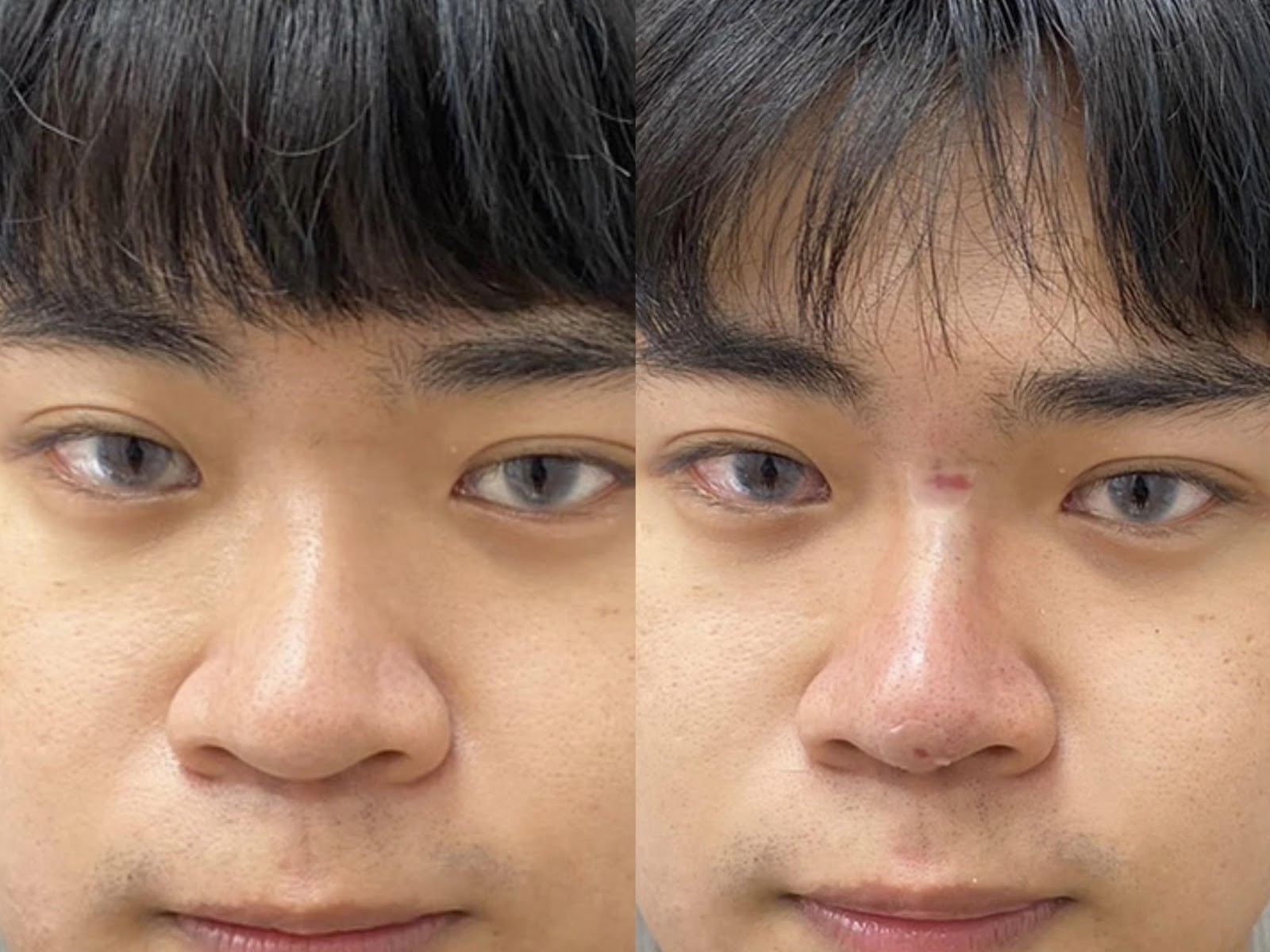 陳裕豪醫師4D三段式埋線隆鼻|皮醫美南勢角診所