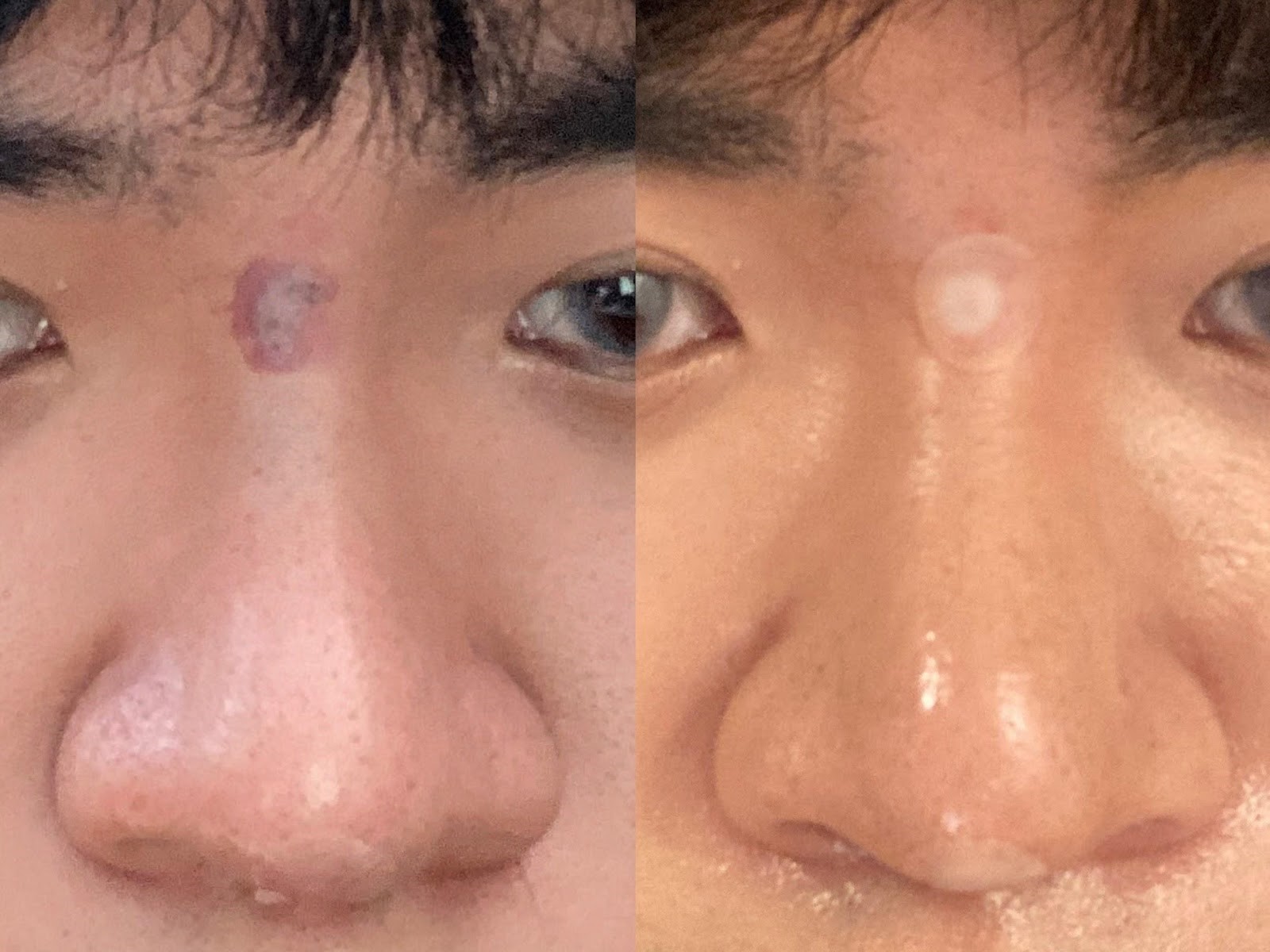 陳裕豪醫師4D三段式埋線隆鼻|皮醫美南勢角診所
