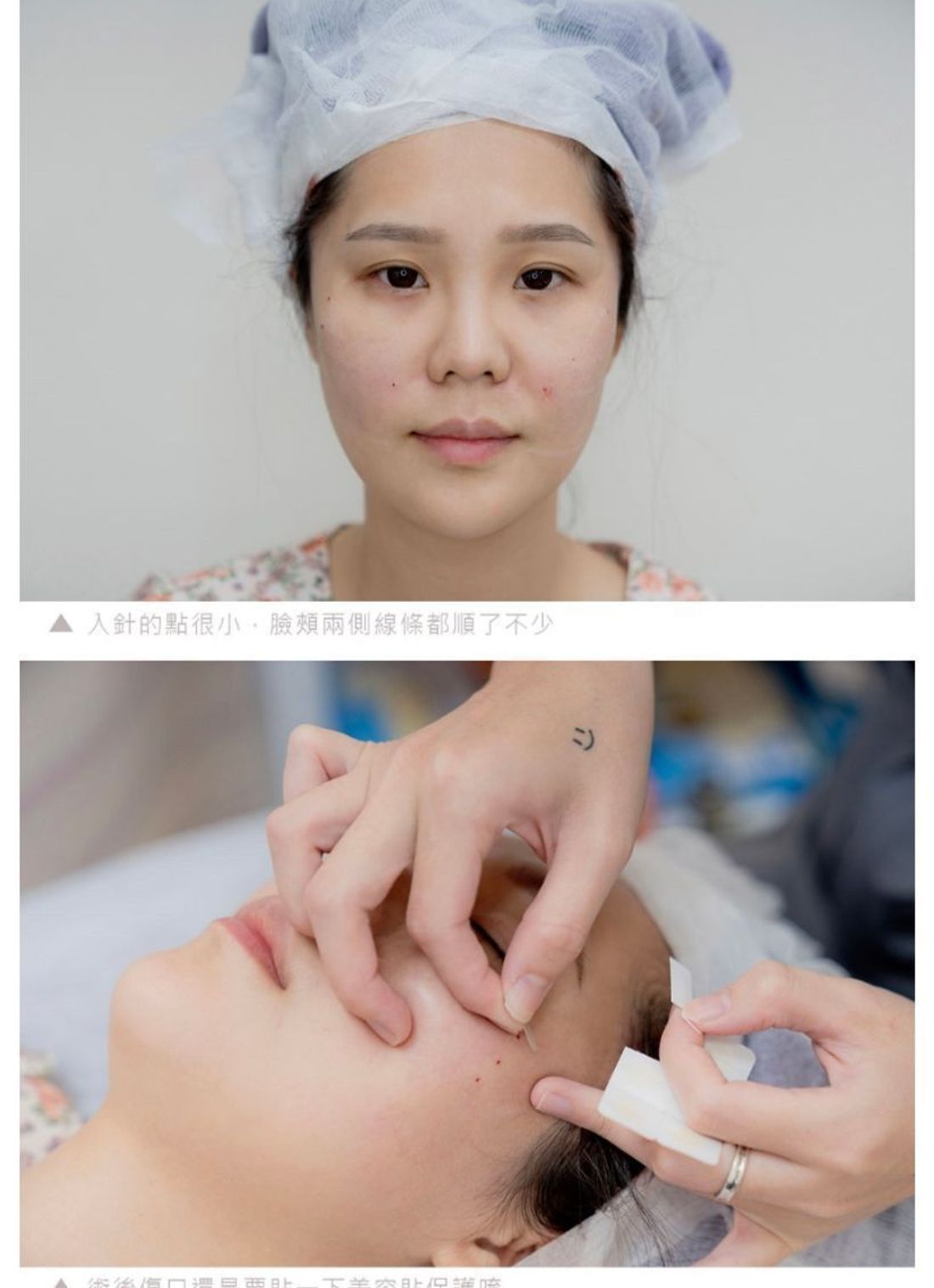 陳裕豪醫師無痛技術筋膜多層次埋線拉提|皮醫美南勢角診所