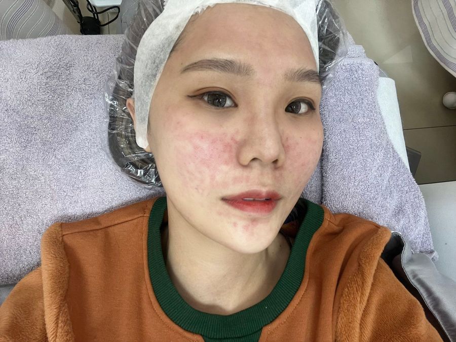 陳裕豪醫師雞尾酒技術皮秒除斑|皮醫美南勢角診所