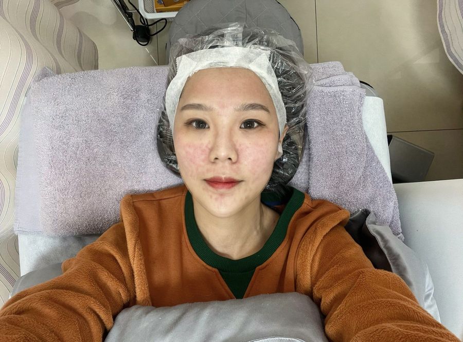 陳裕豪醫師雞尾酒技術皮秒除斑|皮醫美南勢角診所