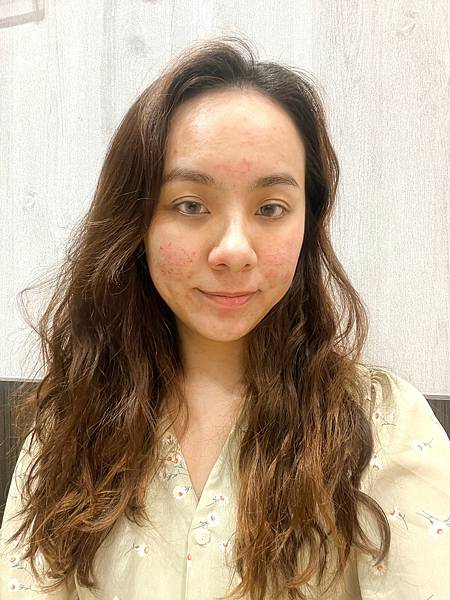 陳裕豪醫師雞尾酒技術皮秒除斑|皮醫美南勢角診所
