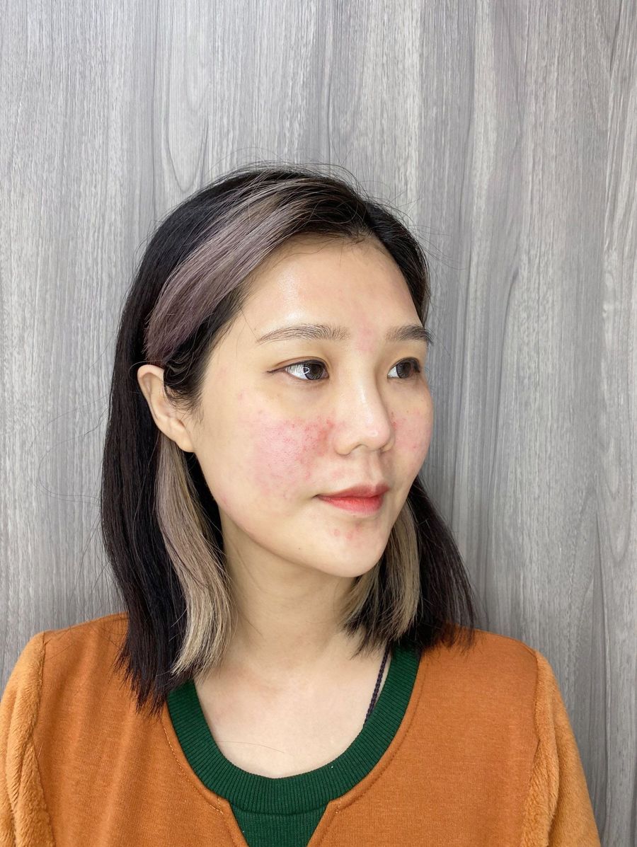 陳裕豪醫師雞尾酒技術皮秒除斑|皮醫美南勢角診所