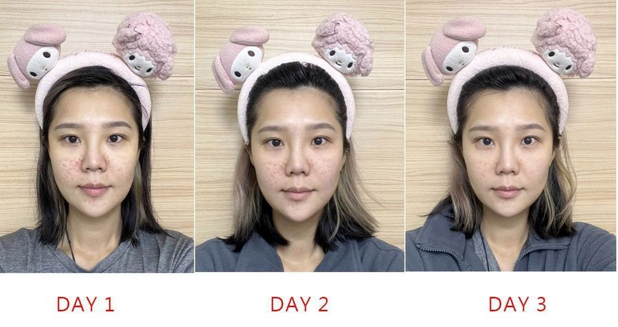 陳裕豪醫師雞尾酒技術皮秒除斑|皮醫美南勢角診所