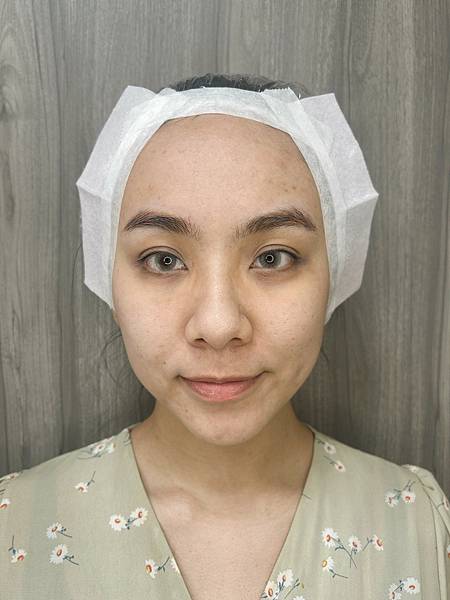 陳裕豪醫師雞尾酒技術皮秒除斑|皮醫美南勢角診所