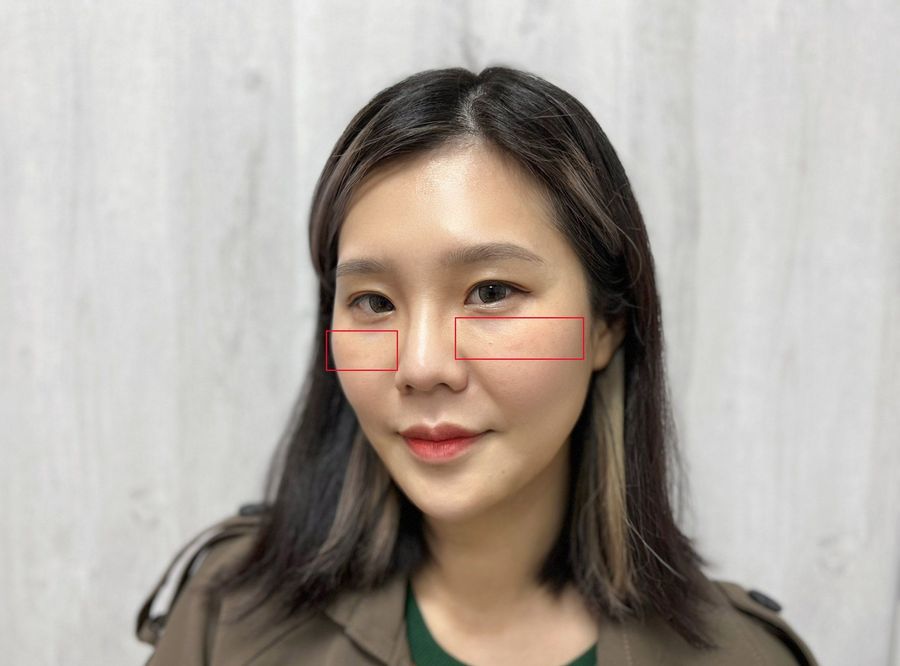 陳裕豪醫師雞尾酒技術皮秒除斑|皮醫美南勢角診所