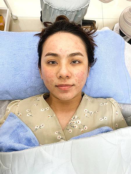 陳裕豪醫師雞尾酒技術皮秒除斑|皮醫美南勢角診所