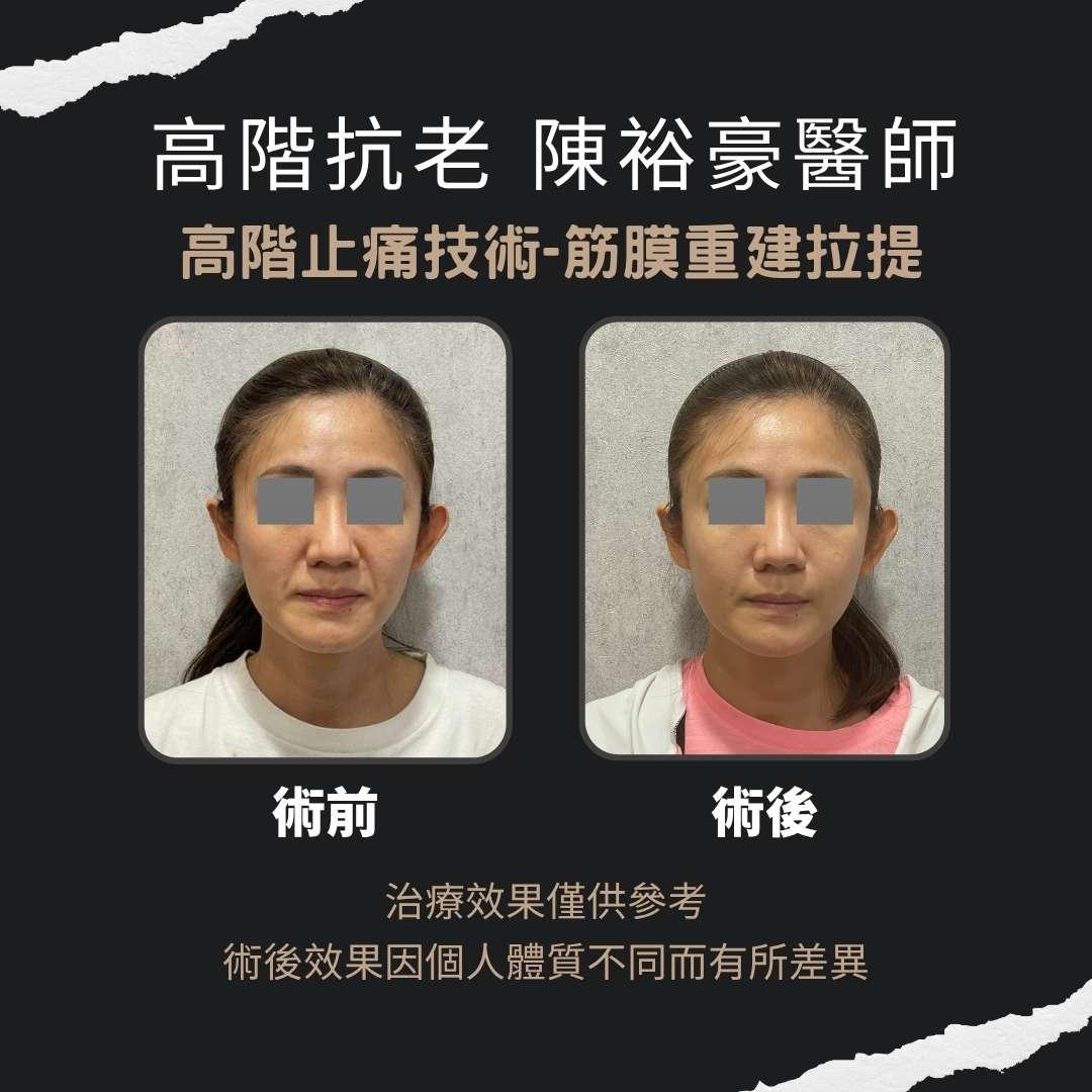 陳裕豪醫師 -筋膜拉提AB1