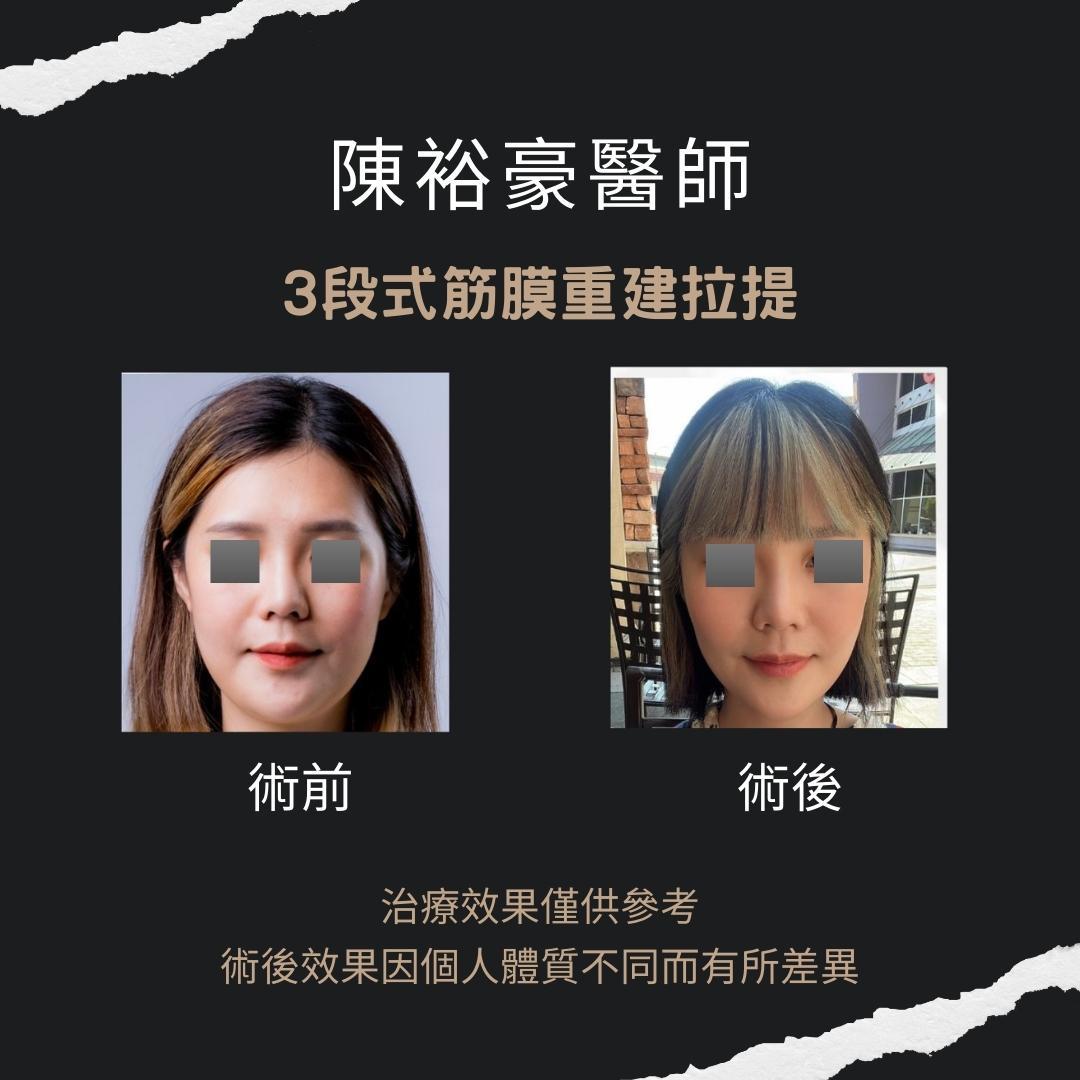 陳裕豪醫師 -筋膜拉提AB2