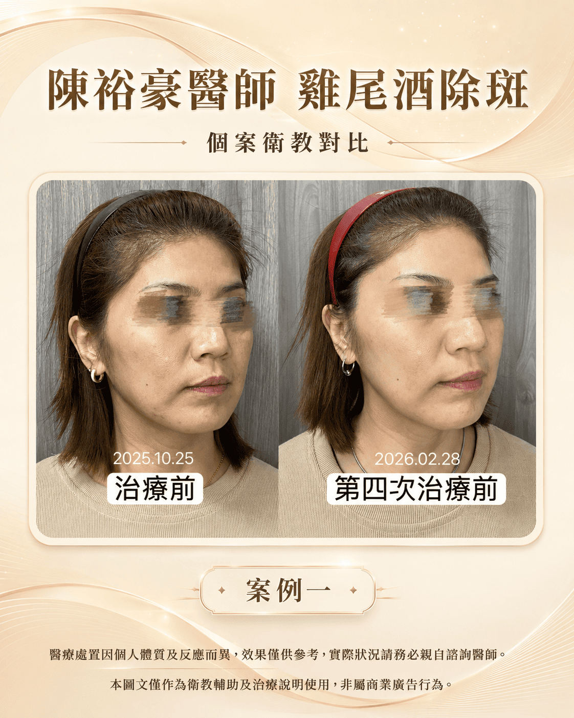 皮秒雷射