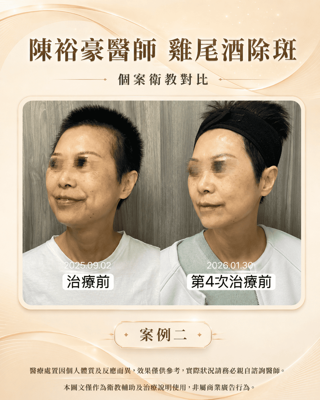 皮秒雷射