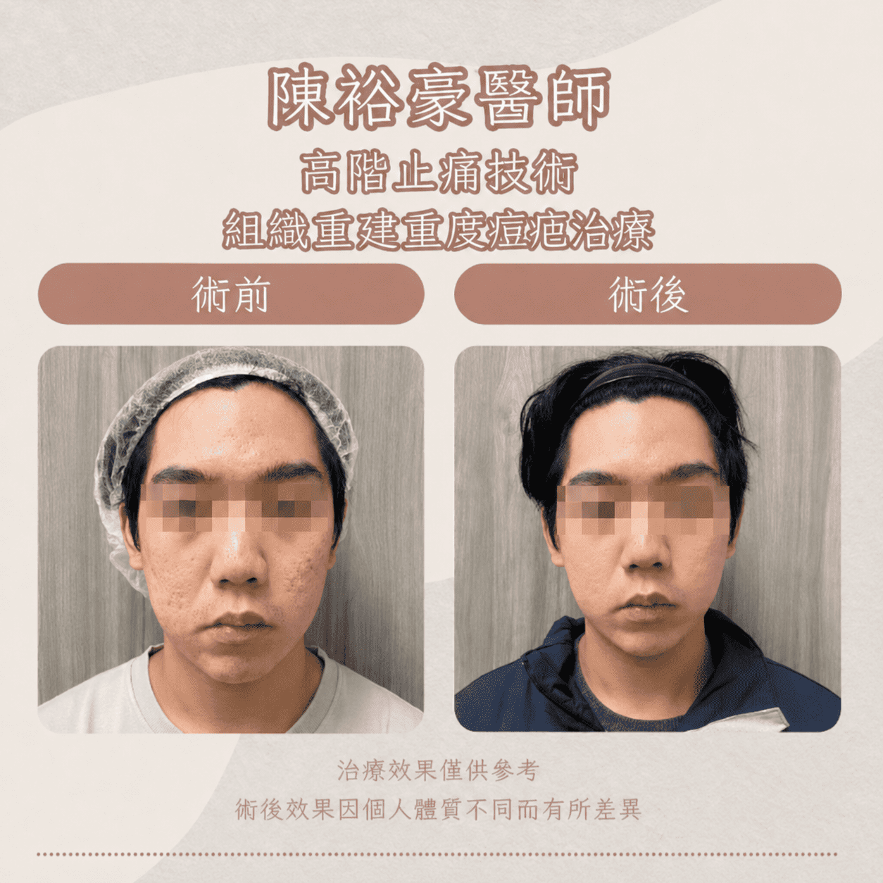 高階抗老 陳裕豪醫師 痘疤治療