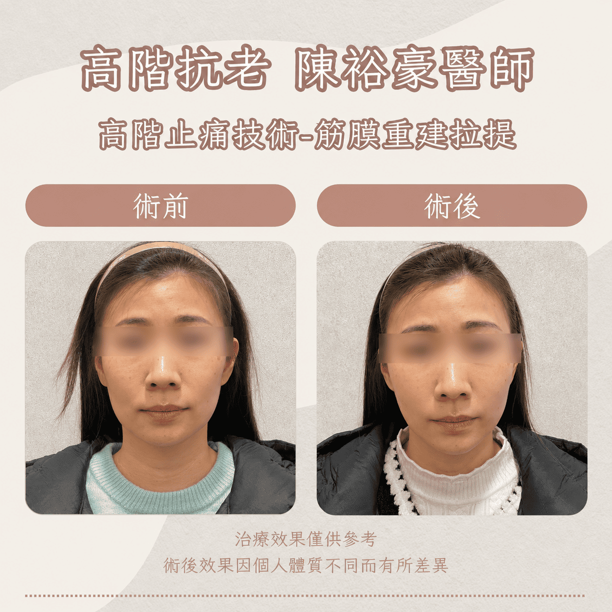 瑞提診所陳裕豪醫師女性筋膜拉提與埋線拉提案例，術前術後正面比較中下臉與下顎線輪廓變化