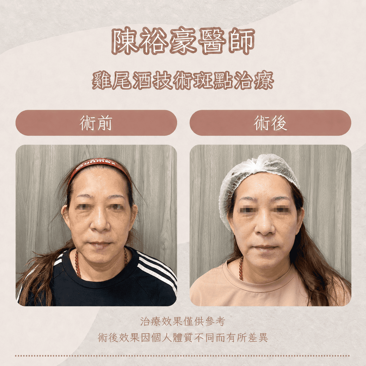 高階抗老 陳裕豪醫師 皮秒除斑