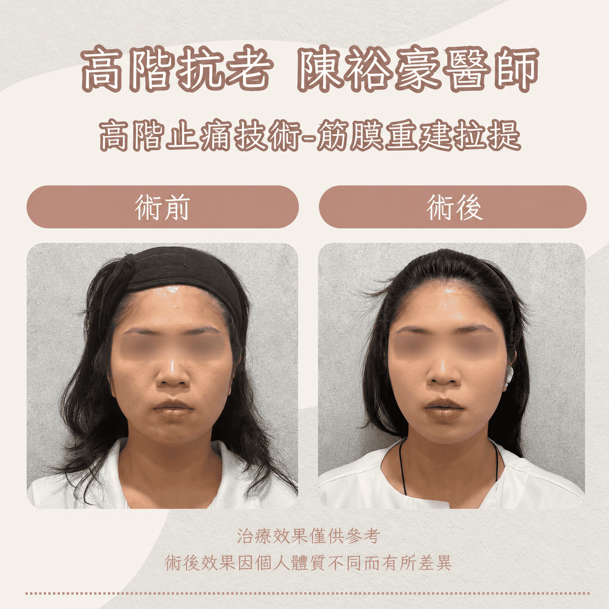 高階抗老 陳裕豪醫師 高階止痛技術-筋膜重建抗老拉提