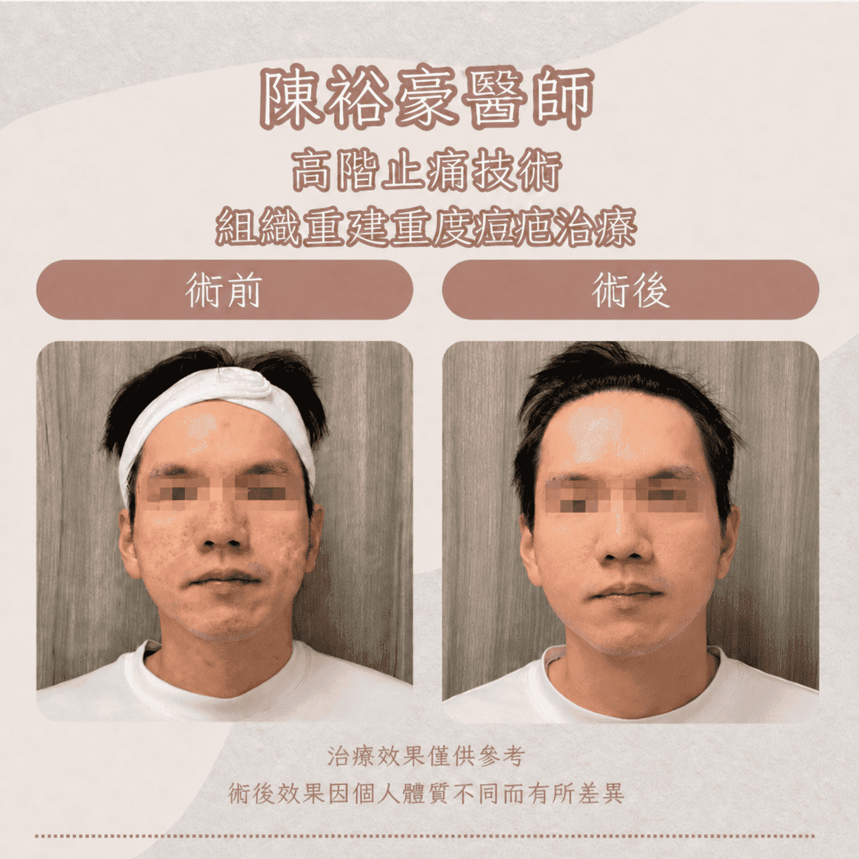 高階抗老 陳裕豪醫師 痘疤 凹疤 皮下剝離