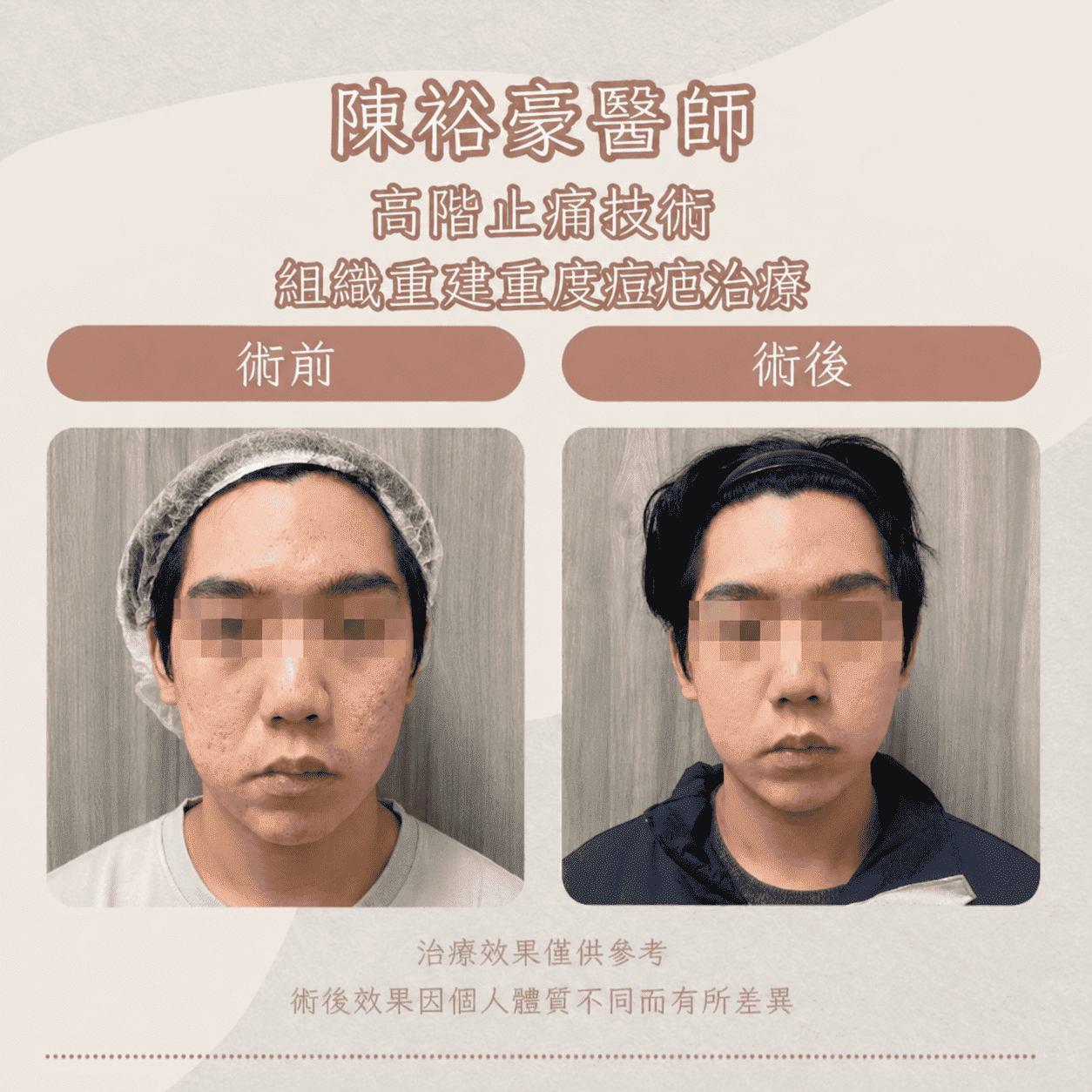 高階抗老 陳裕豪醫師 痘疤 凹疤 皮下剝離