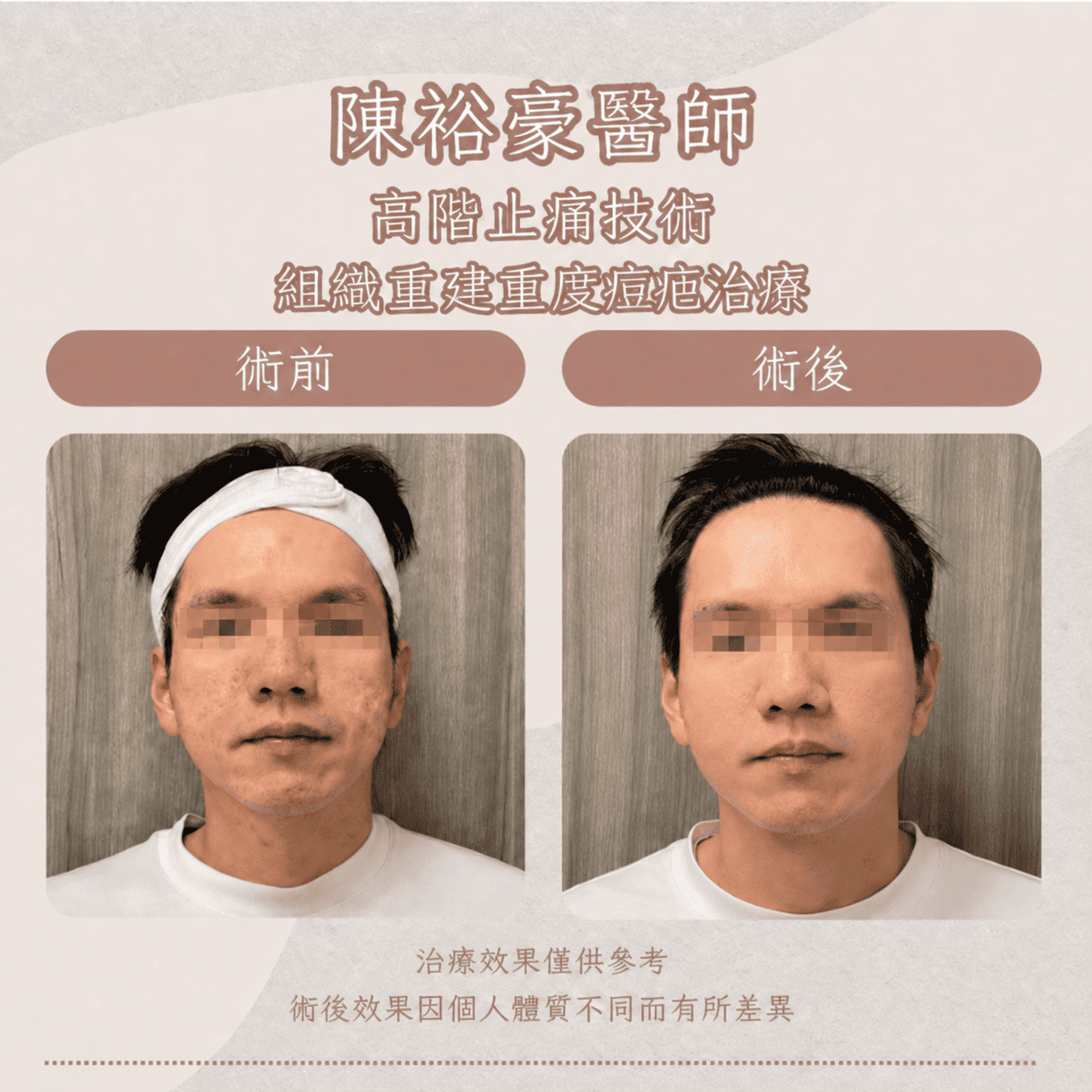 瑞提診所陳裕豪醫師男性混合型凹痘疤治療案例，術前術後比較雙頰與顳側凹陷、痘疤陰影及膚質變化
