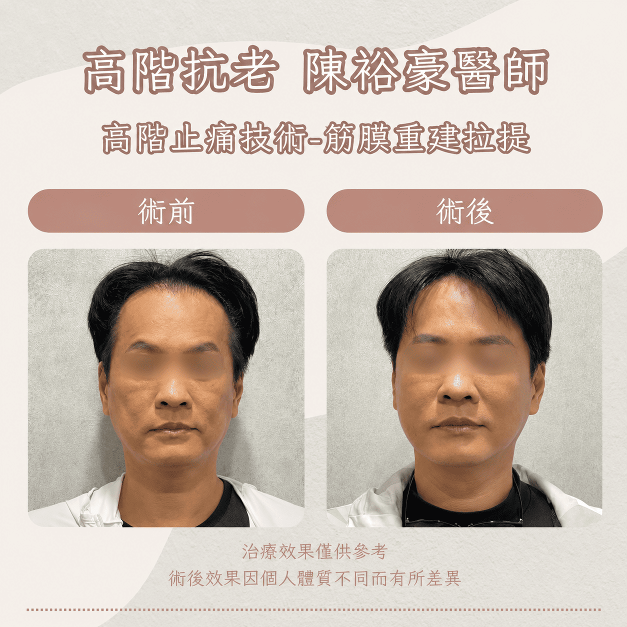 高階抗老 陳裕豪醫師 高階止痛技術-筋膜重建抗老拉提