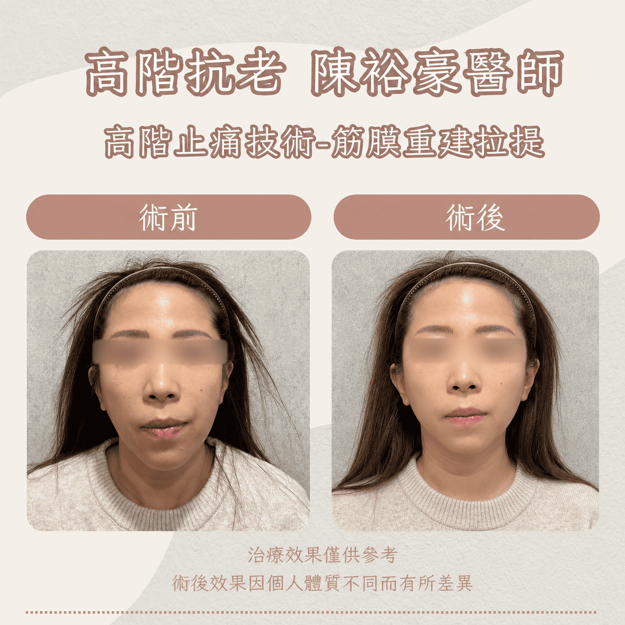 瑞提診所陳裕豪醫師女性筋膜拉提與埋線拉提案例，術前術後比較臉頰鬆弛、嘴邊肉與下顎線輪廓變化