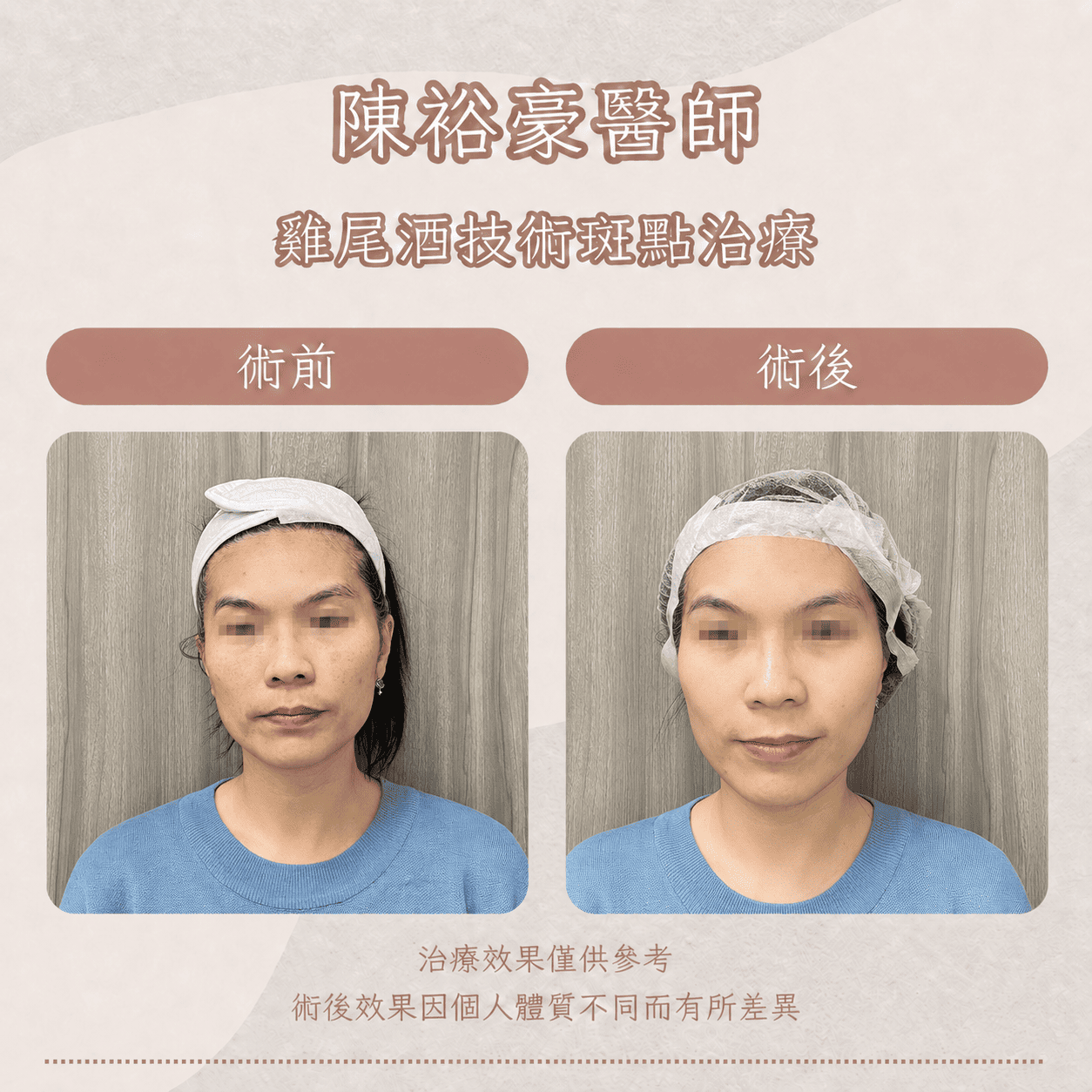高階抗老 陳裕豪醫師 皮秒除斑 雞尾酒技術皮秒雷射除斑| 瑞提診所 | IN艾娜蓓是由陳裕豪醫師推薦的低刺激保養品牌，針對敏感肌、乾燥肌與雷射療程後肌膚乾燥緊繃族群，提供溫和清潔、保濕補水與屏障照護型保養選擇