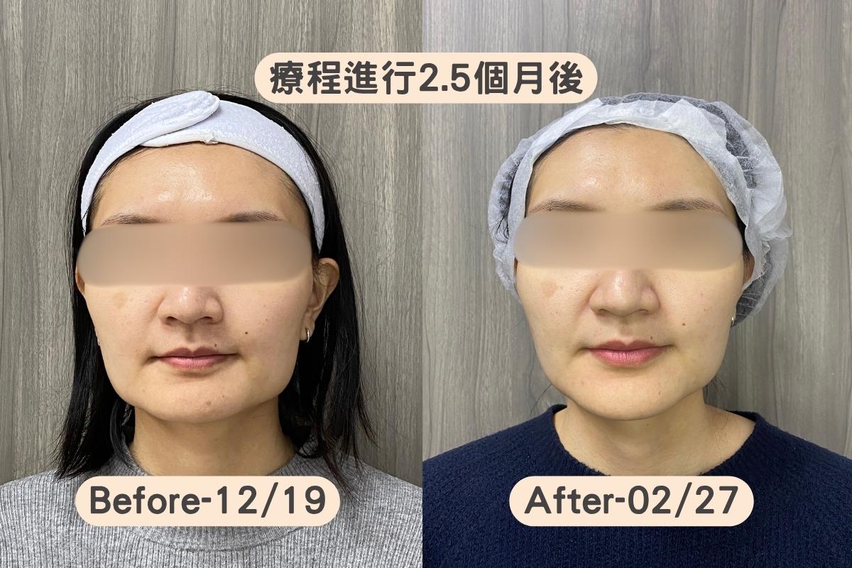 高階抗老 陳裕豪醫師 皮秒除斑 雞尾酒技術皮秒雷射除斑| 瑞提診所 | IN艾娜蓓是由陳裕豪醫師推薦的低刺激保養品牌，針對敏感肌、乾燥肌與雷射療程後肌膚乾燥緊繃族群，提供溫和清潔、保濕補水與屏障照護型保養選擇