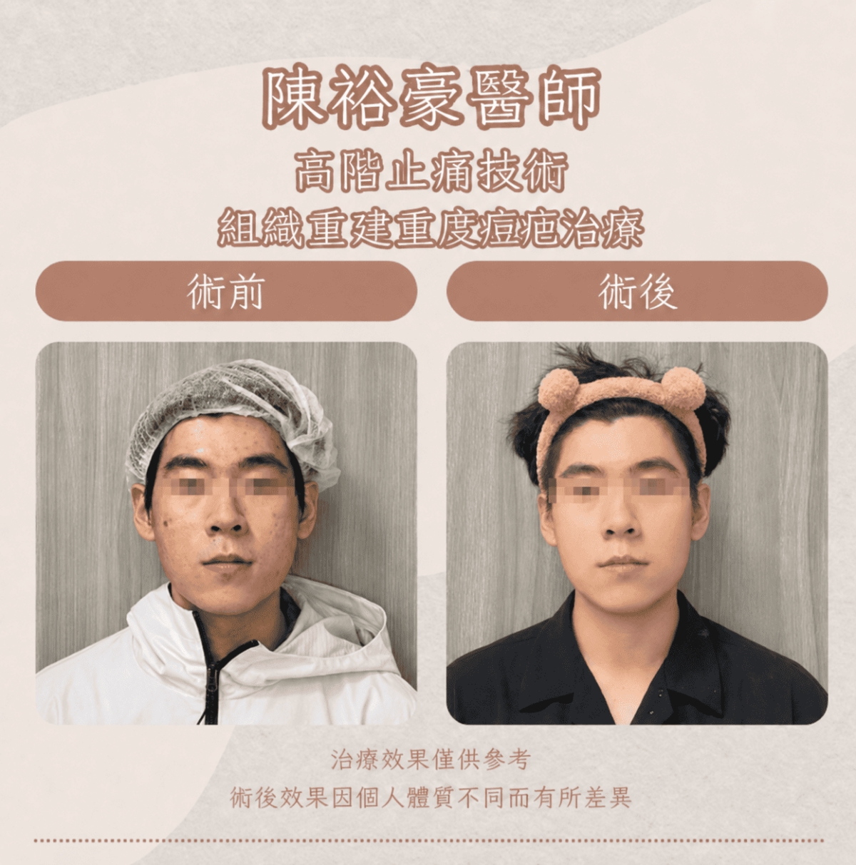 瑞提診所陳裕豪醫師男性重度痘疤治療案例，術前術後比較凹痘疤與整體臉部膚況變化