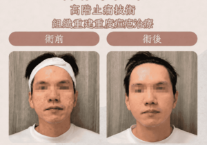 高階抗老 陳裕豪醫師 痘疤 凹疤 皮下剝離