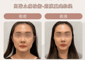 埋線拉提1_0