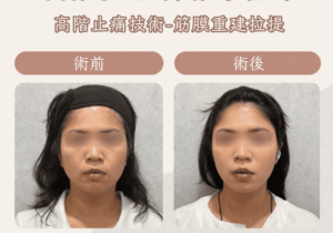埋線拉提2_0