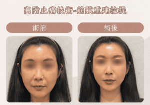 埋線拉提7_0