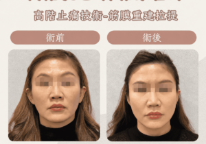 埋線拉提8_0