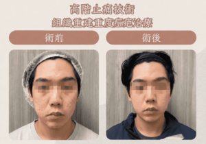 痘疤1_0