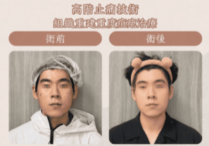 痘疤2_0